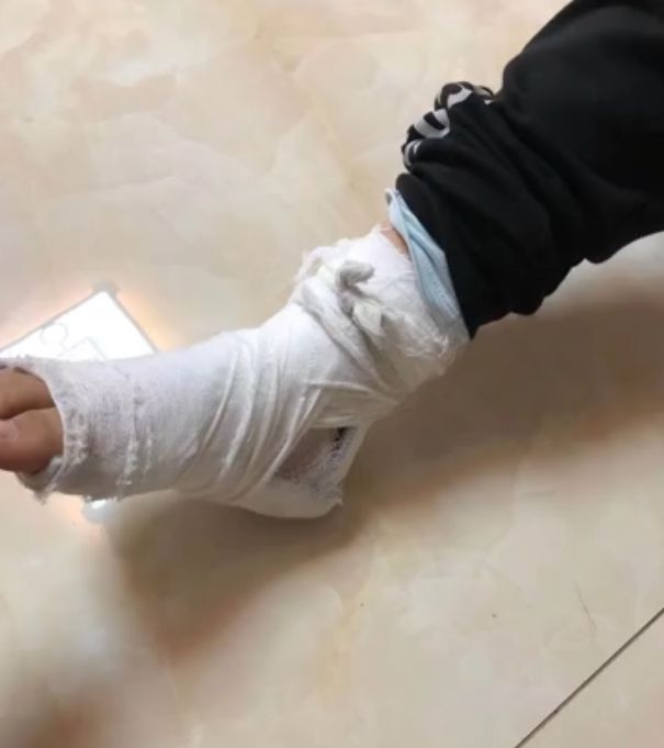 骨折光_骨折了多久可以恢复_骨折了吃什么促进骨头愈合